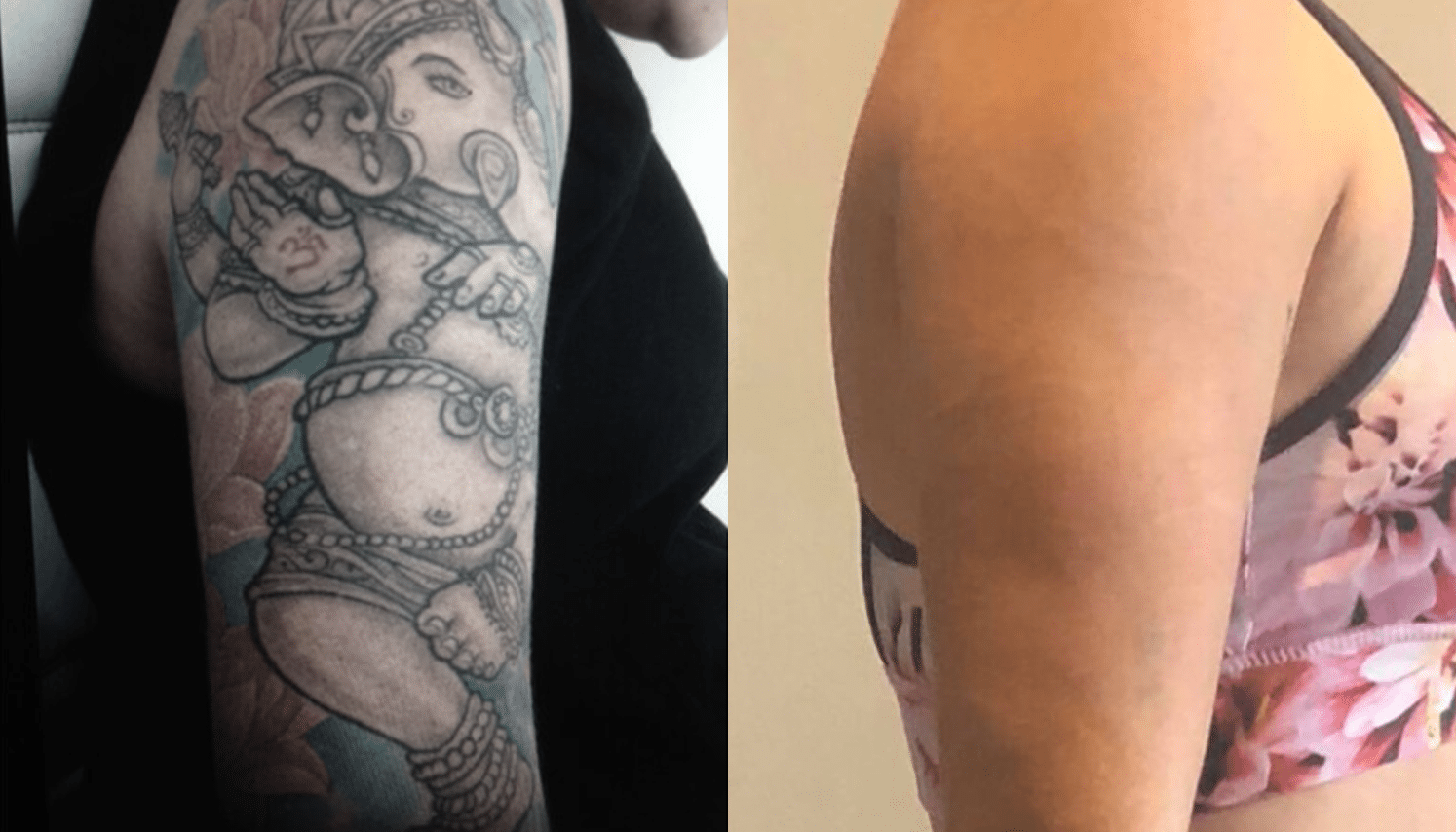Remoção de Tatuagem com Laser - Goiânia 7 Tattoo-Laser-1