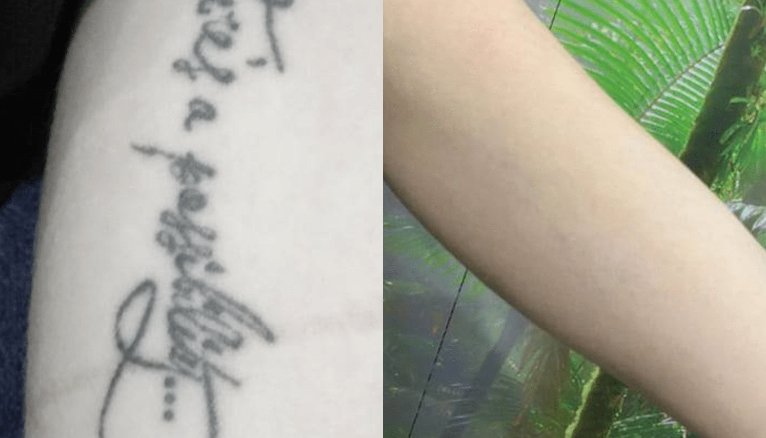 Remoção de Tatuagem com Laser - Goiânia 16 Tattoo-Laser-10