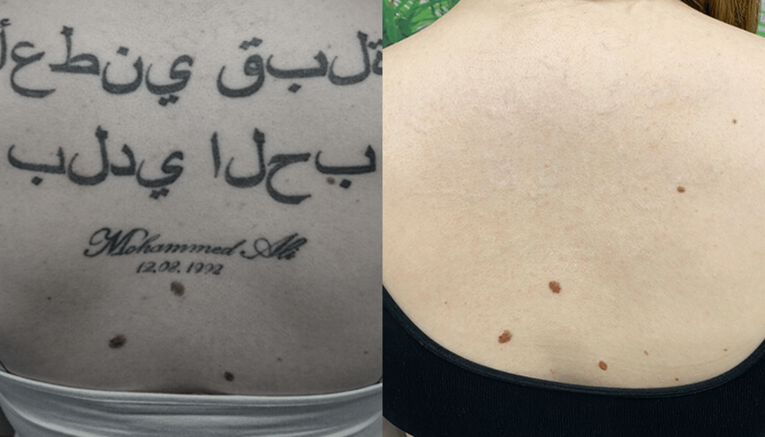 Remoção de Tatuagem com Laser - Goiânia 8 Tattoo-Laser-2