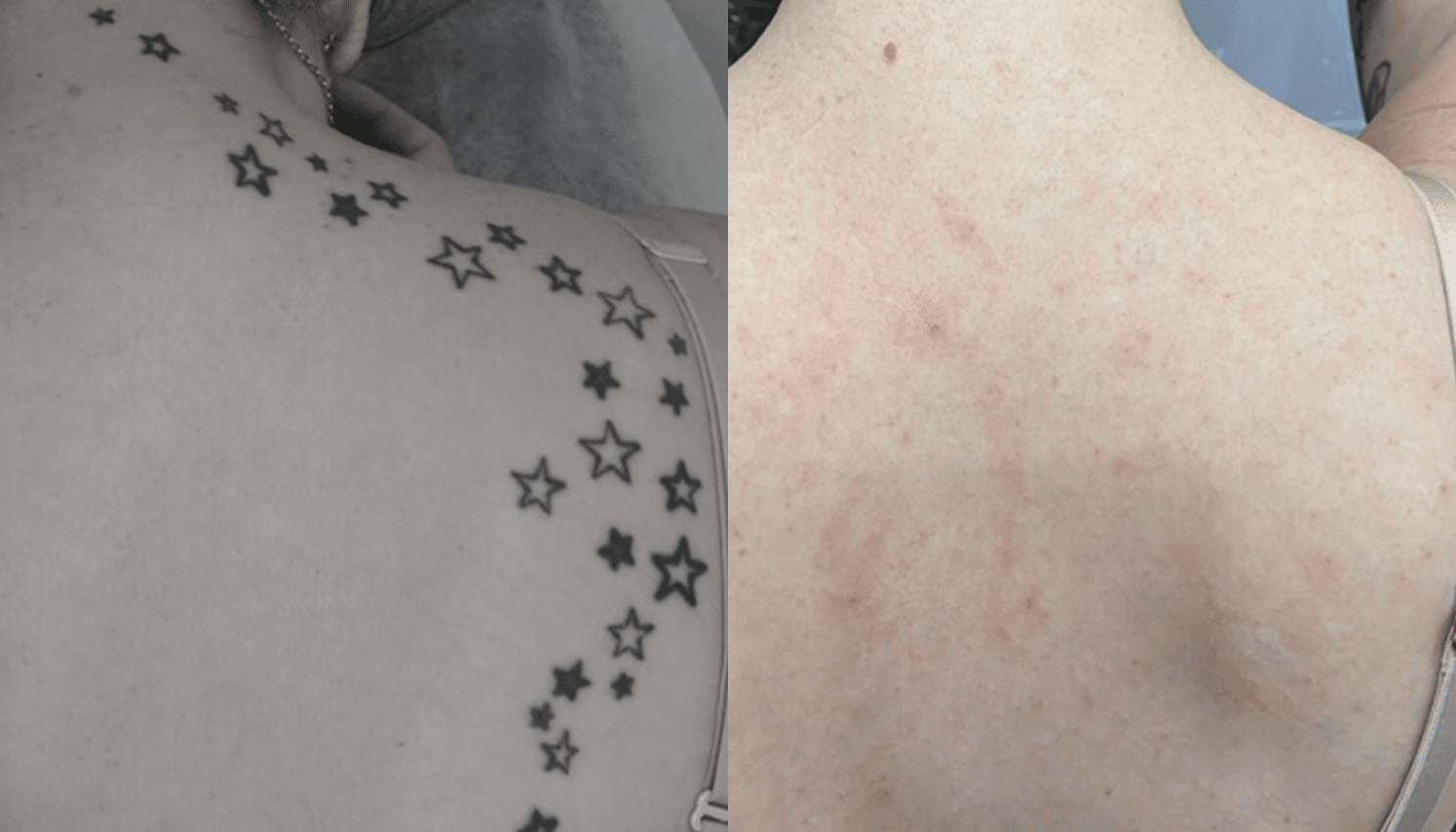 Remoção de Tatuagem com Laser - Goiânia 9 Tattoo-Laser-3