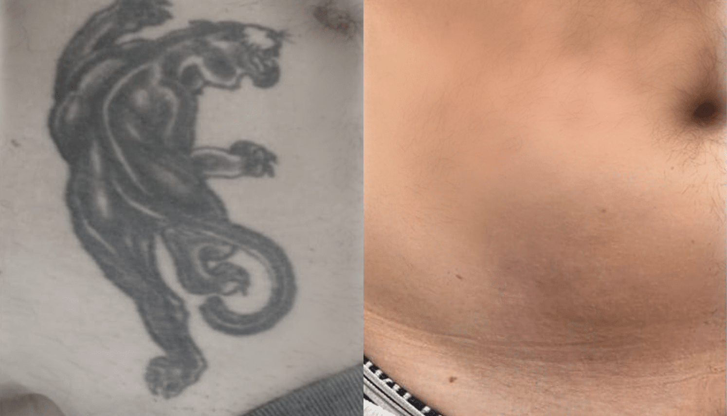 Remoção de Tatuagem com Laser - Goiânia 10 Tattoo-Laser-4