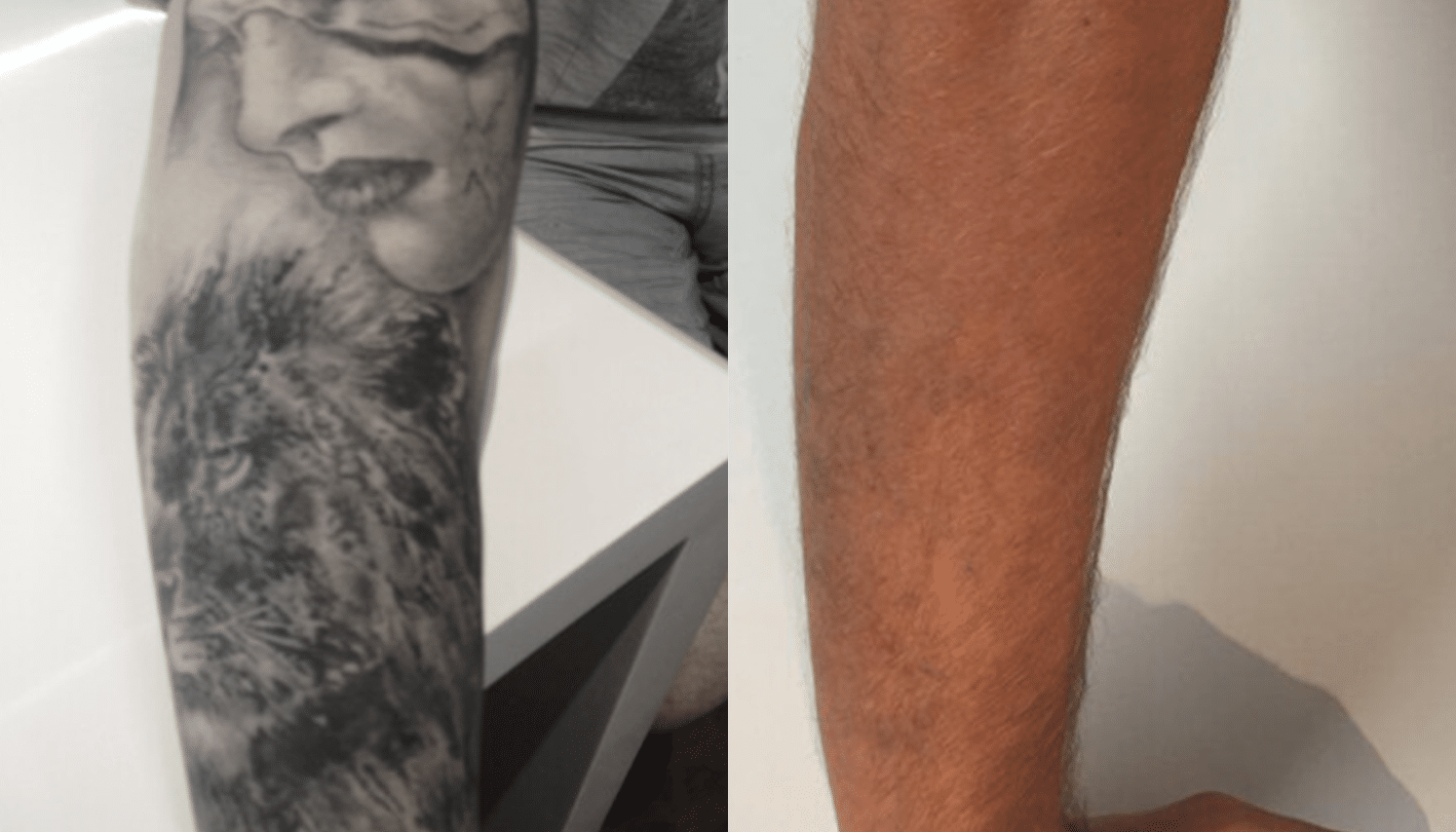 Remoção de Tatuagem com Laser - Goiânia 11 Tattoo-Laser-5