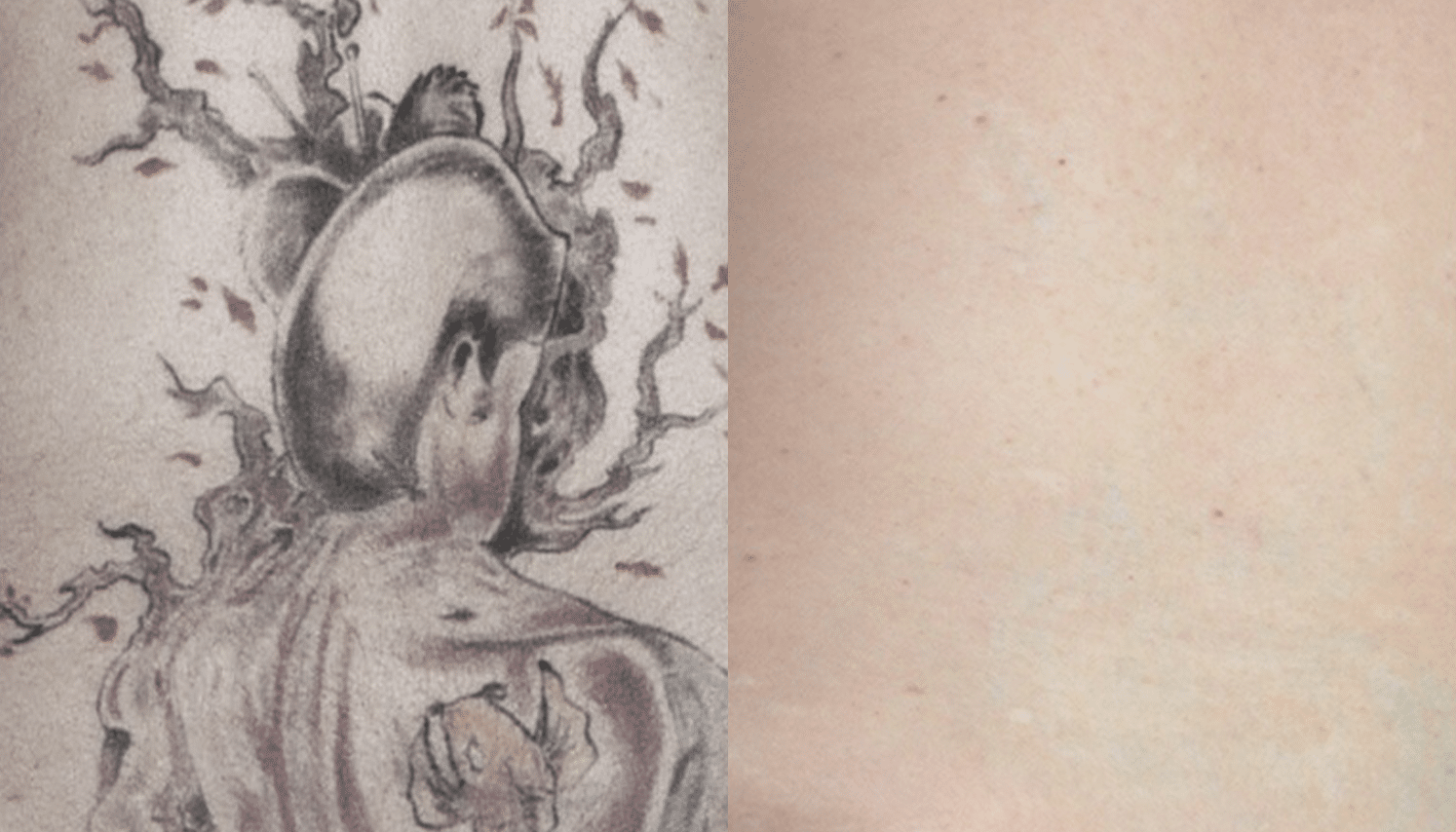 Remoção de Tatuagem com Laser - Goiânia 12 Tattoo-Laser-6