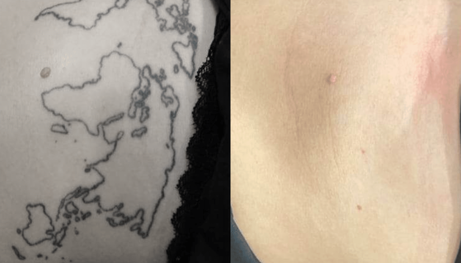 Remoção de Tatuagem com Laser - Goiânia 13 Tattoo-Laser-7