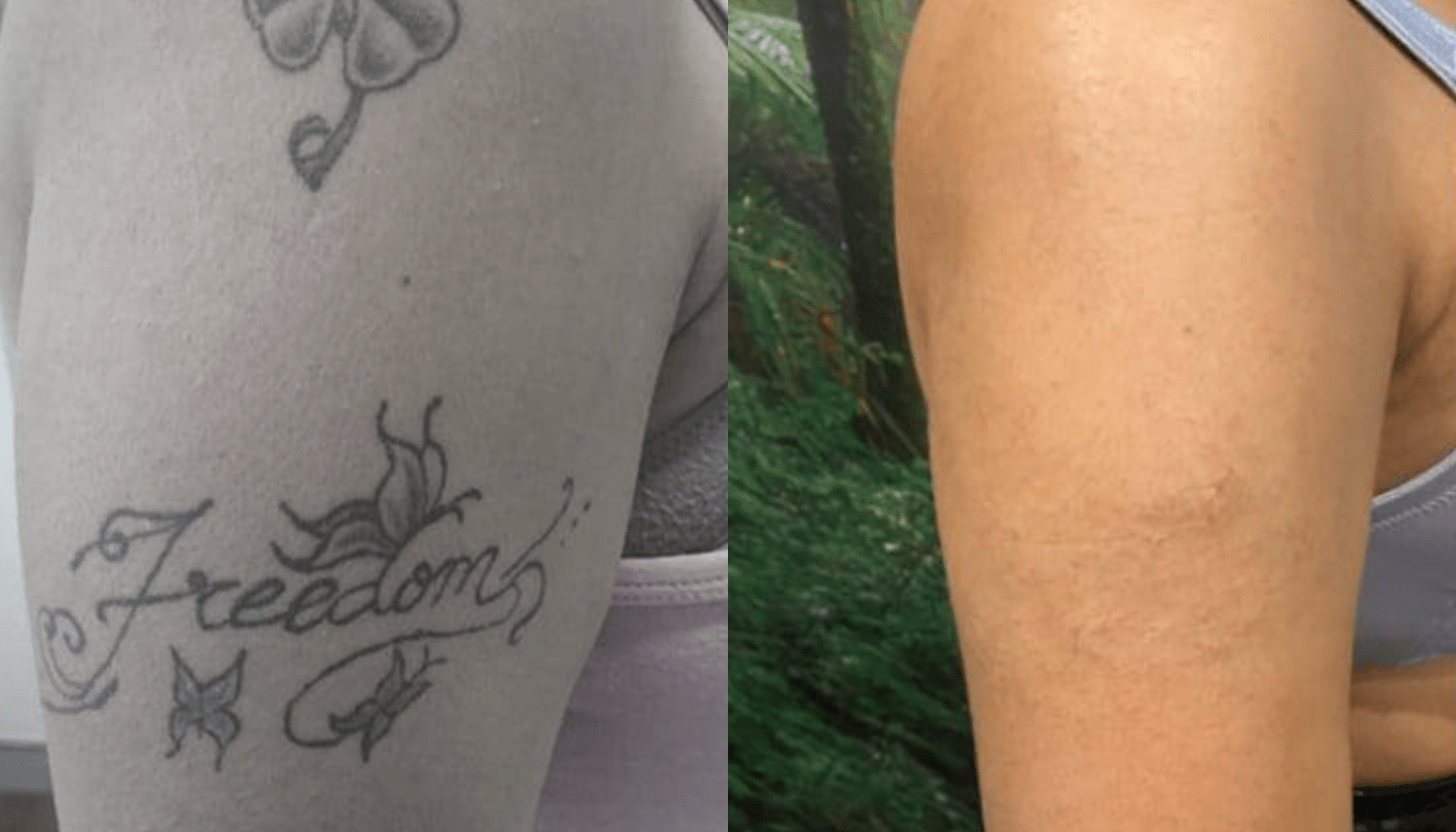Remoção de Tatuagem com Laser - Goiânia 14 Tattoo-Laser-8