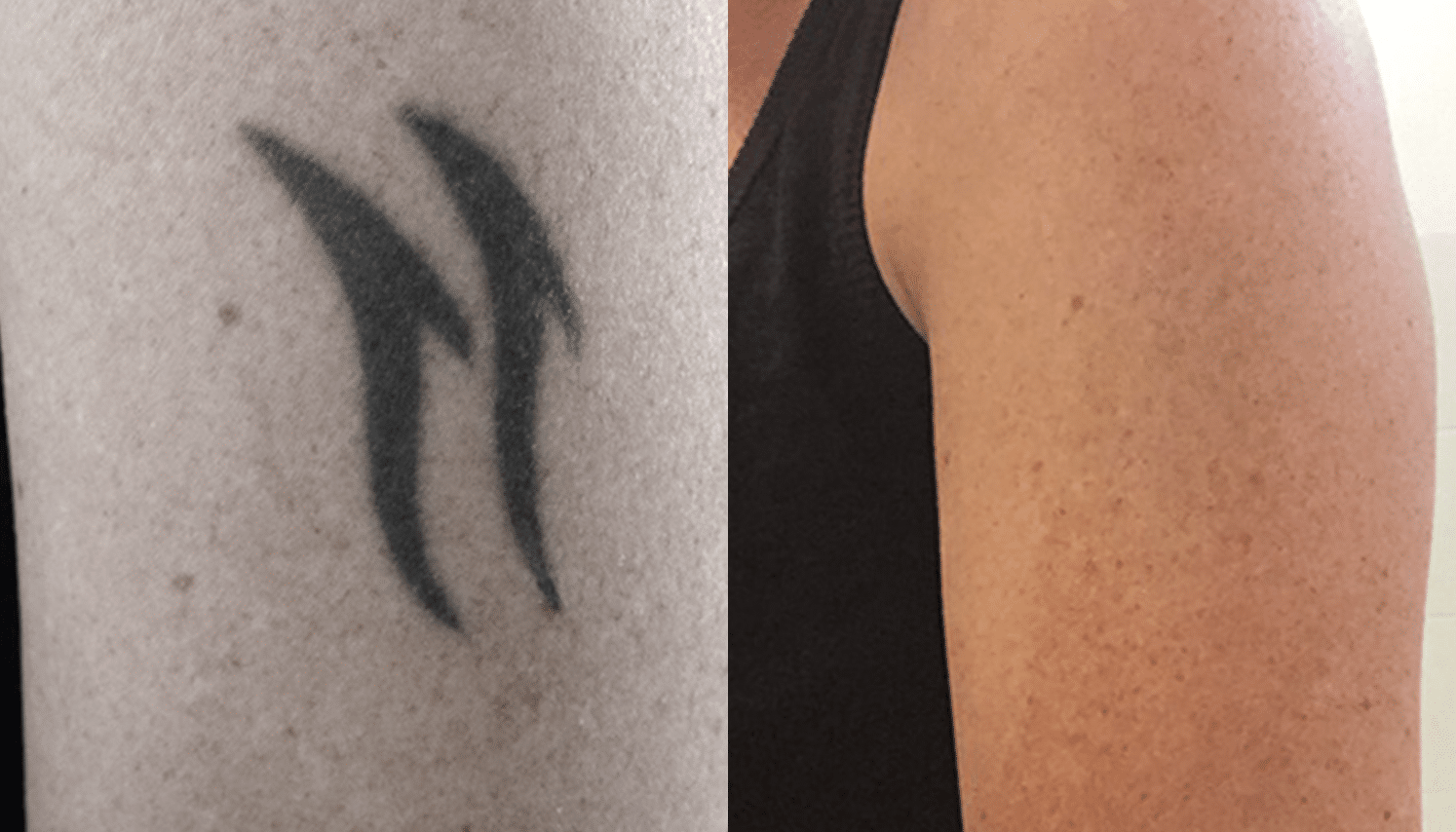 Remoção de Tatuagem com Laser - Goiânia 15 Tattoo-Laser-9