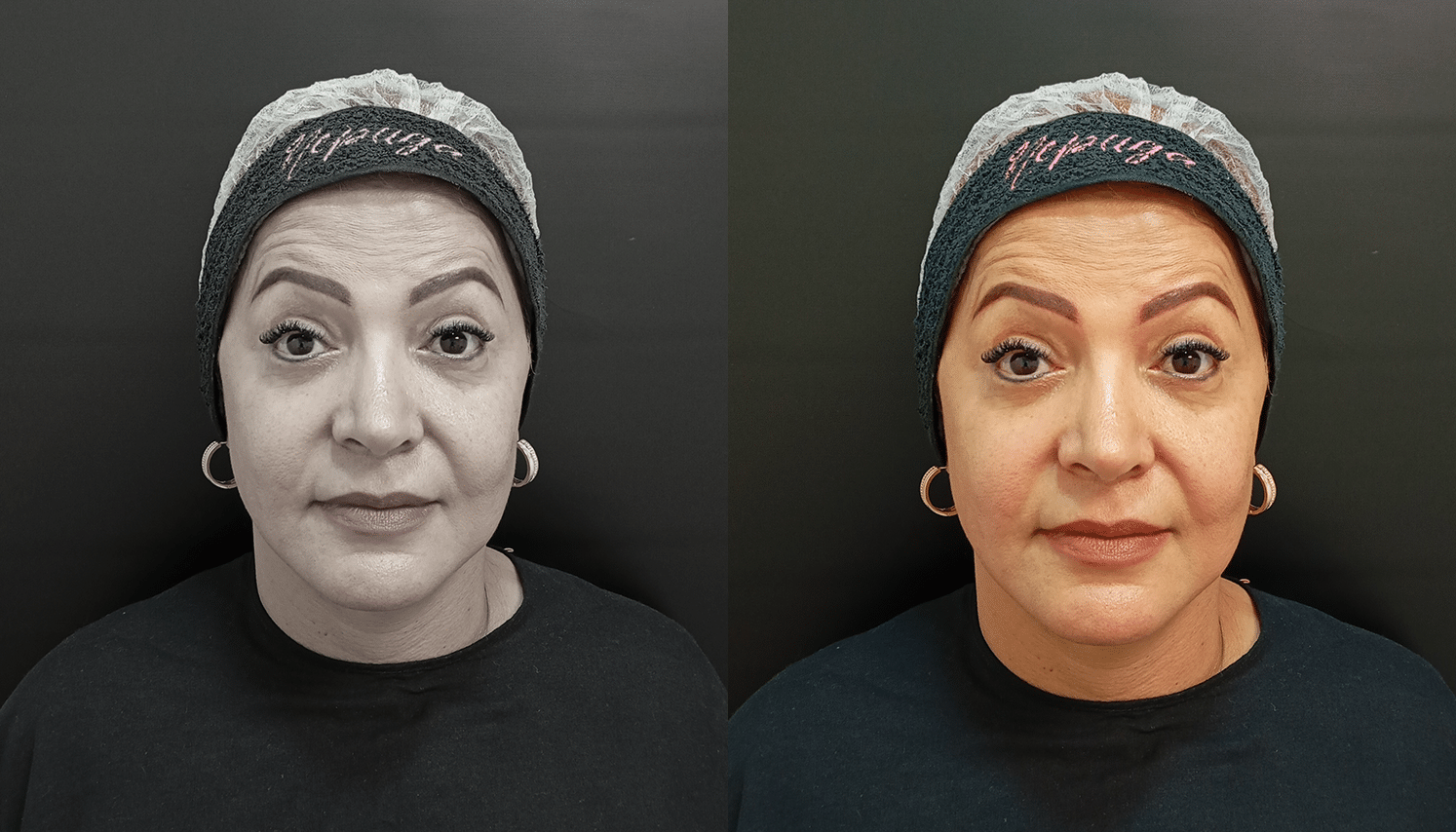 ToxinaBotulinica-Antes e Depois-1