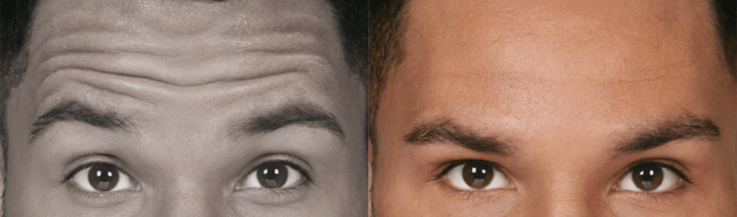 ToxinaBotulinica-Antes e Depois-2