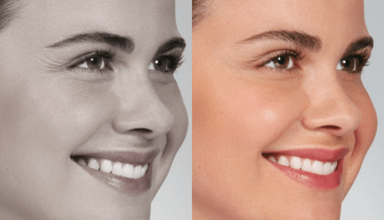 ToxinaBotulinica-Antes e Depois-3
