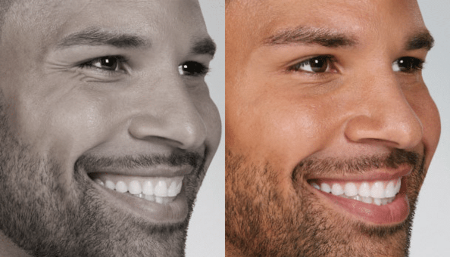 ToxinaBotulinica-Antes e Depois-4