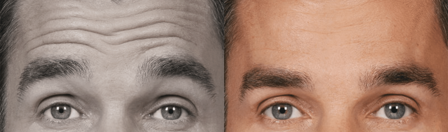 ToxinaBotulinica-Antes e Depois-5