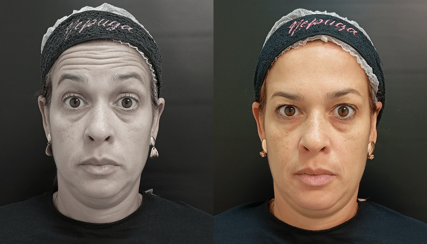 ToxinaBotulinica-Antes e Depois