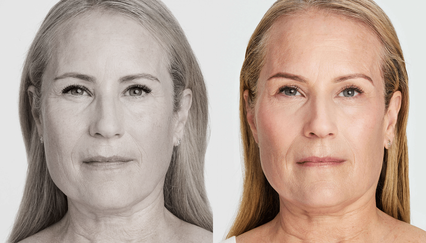 Ultrassom Estético e Microfocado - Salvador 7 Ultrassom-1