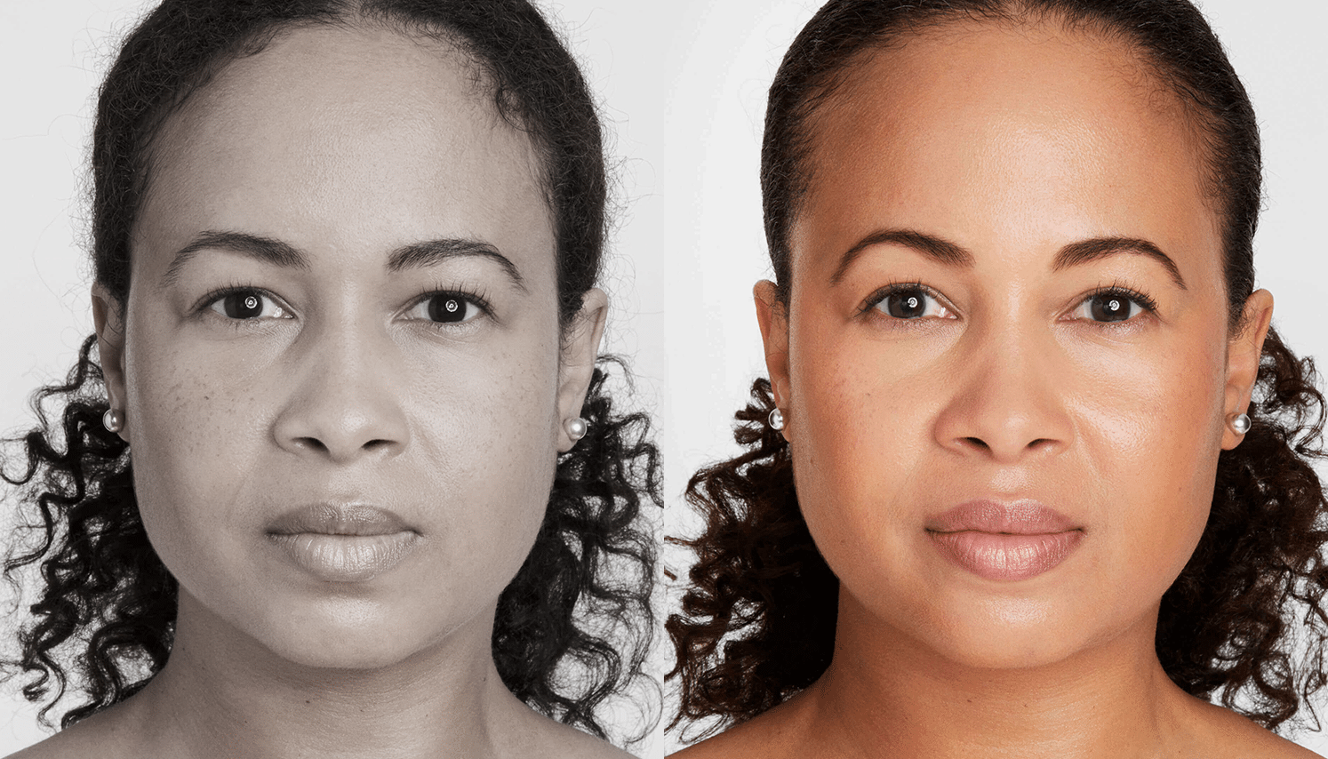 Ultrassom Estético e Microfocado - Salvador 9 Ultrassom-3