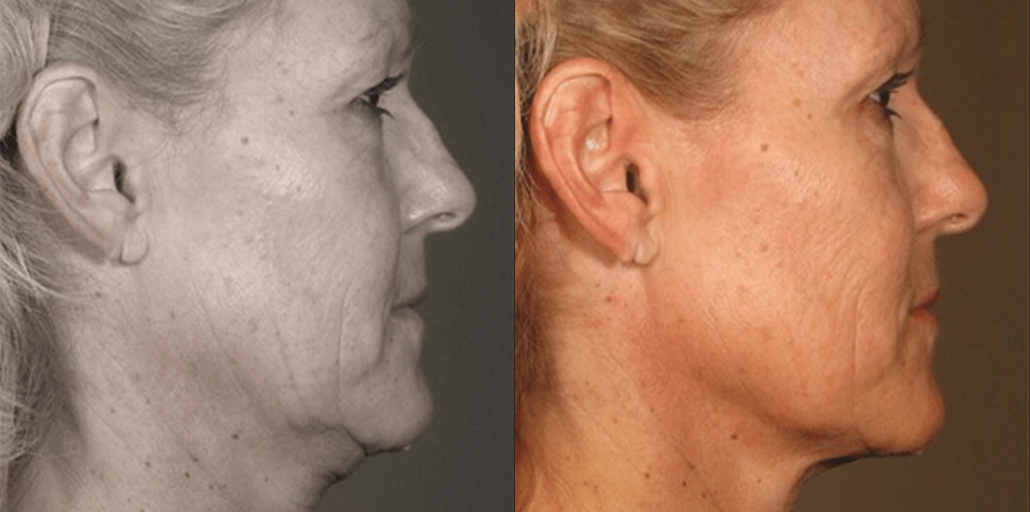 Ultrassom Estético e Microfocado - Salvador 10 Ultrassom-4