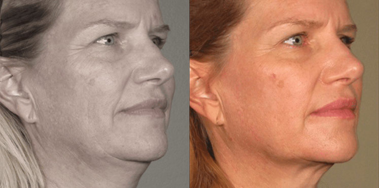 Ultrassom Estético e Microfocado - Salvador 11 Ultrassom-5