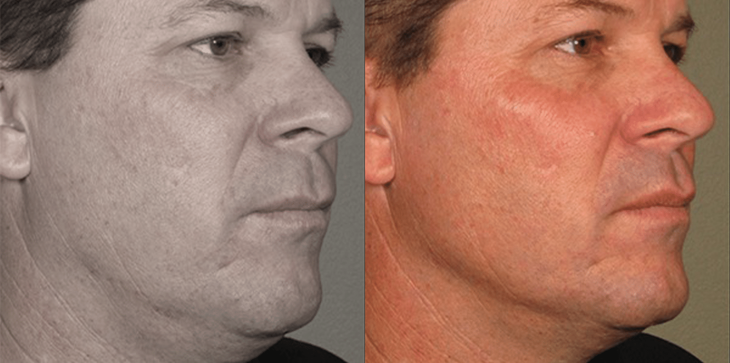 Ultrassom Estético e Microfocado - Salvador 12 Ultrassom-6