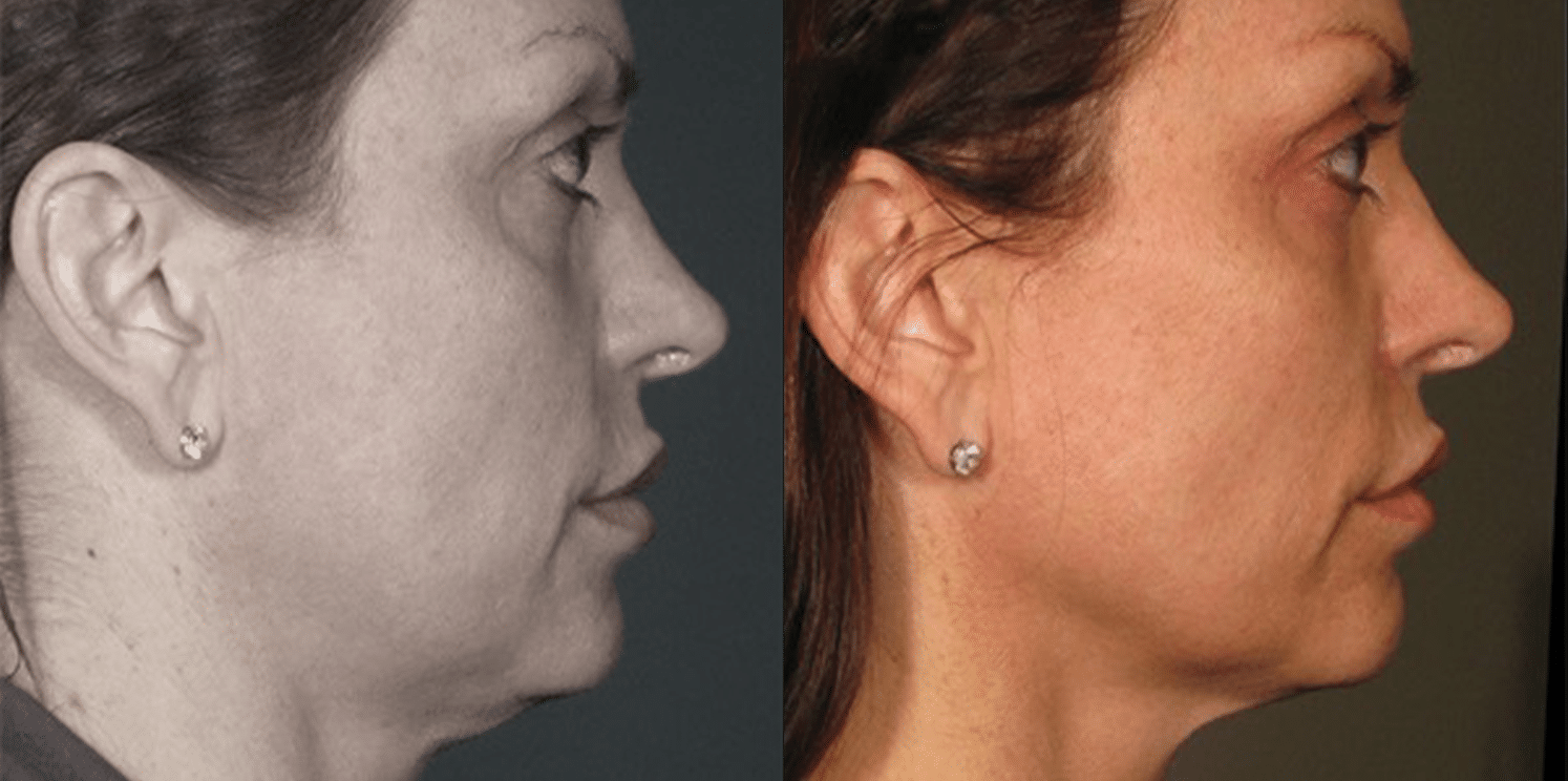 Ultrassom Estético e Microfocado - Salvador 13 Ultrassom-7