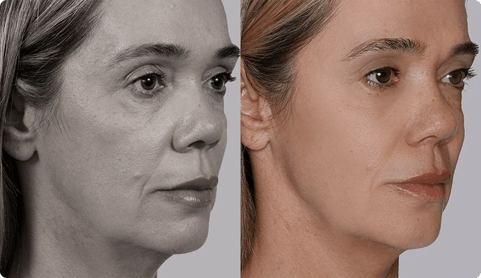 Flavia-Antes e Depois