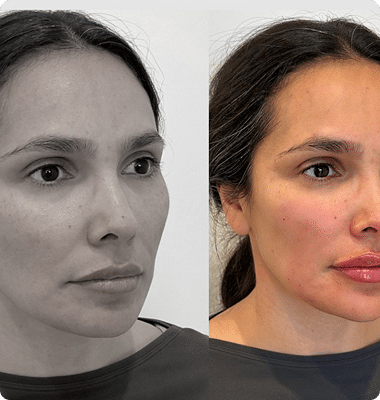 Hamonizacao-facial-2