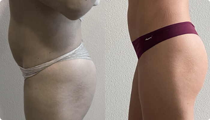 Injeção Intramuscular-1