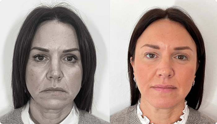 PreechimentoF-Antes e Depois-7