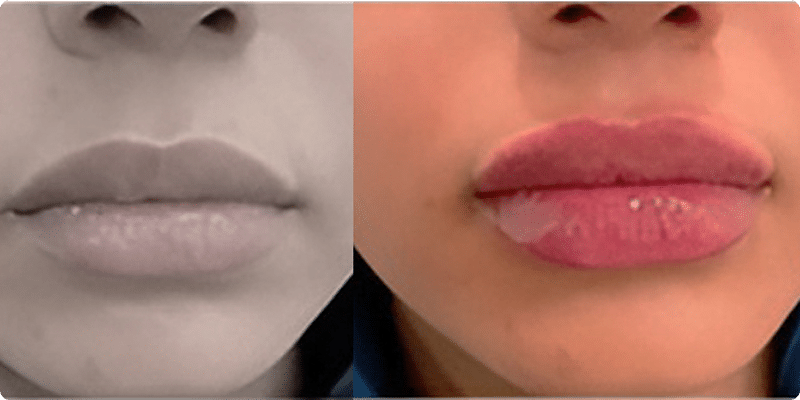 Preenchimento-Labial-10