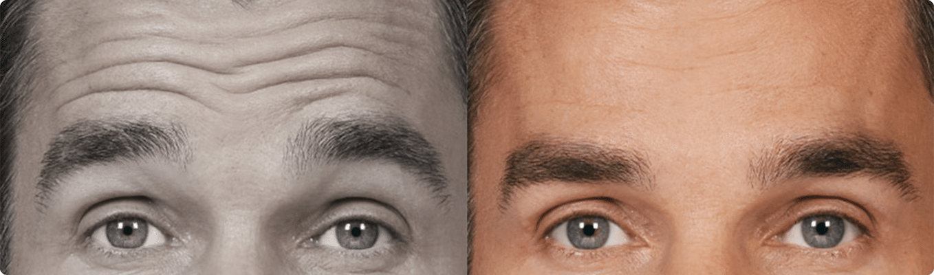 ToxinaBotulinica-Antes e Depois-5