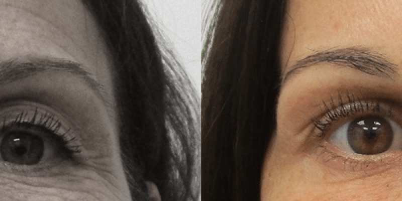 Carboxiterapia-2