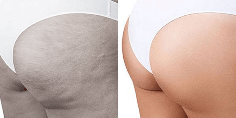Endermoterapia-4