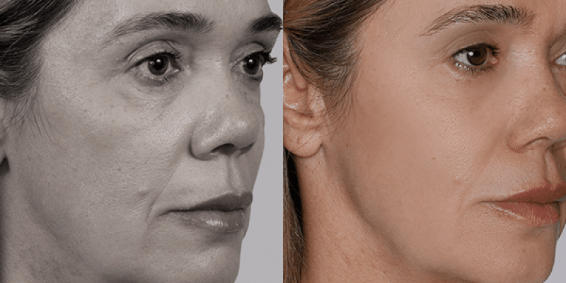 Flavia-Antes e Depois