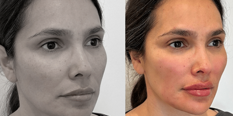 Hamonizacao-facial-2