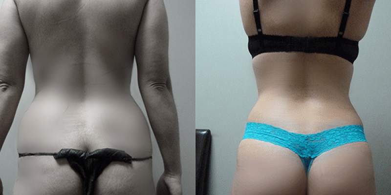 Hidrolipoclasia-7