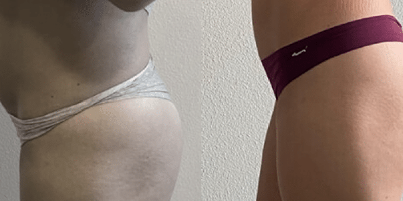 Injeção Intramuscular-1
