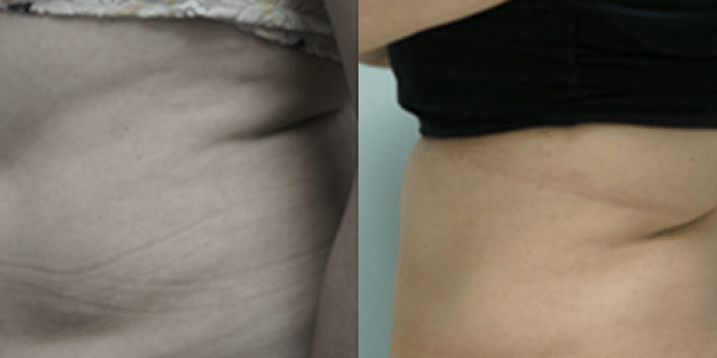 Mesoterapia-6