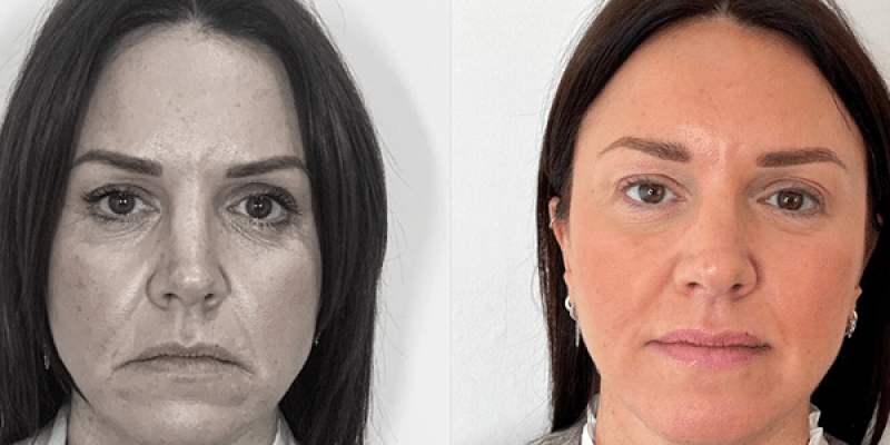 PreechimentoF-Antes e Depois-7