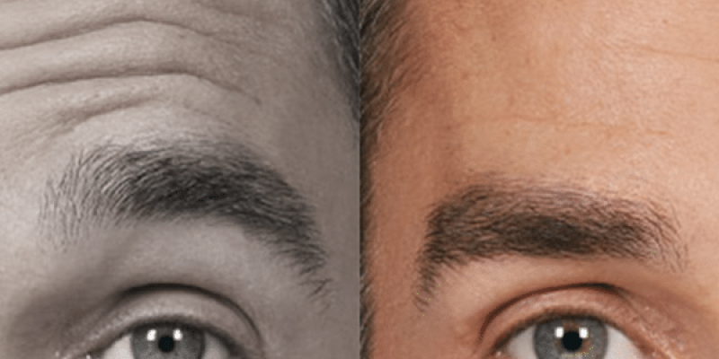 ToxinaBotulinica-Antes e Depois-5