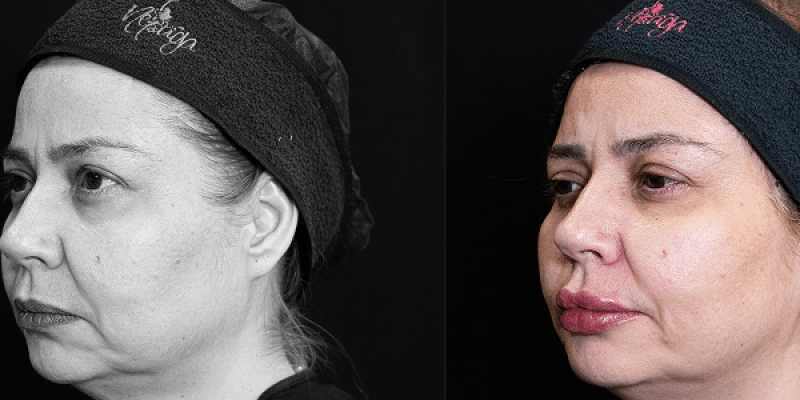 imagem-antes-e-depois 1