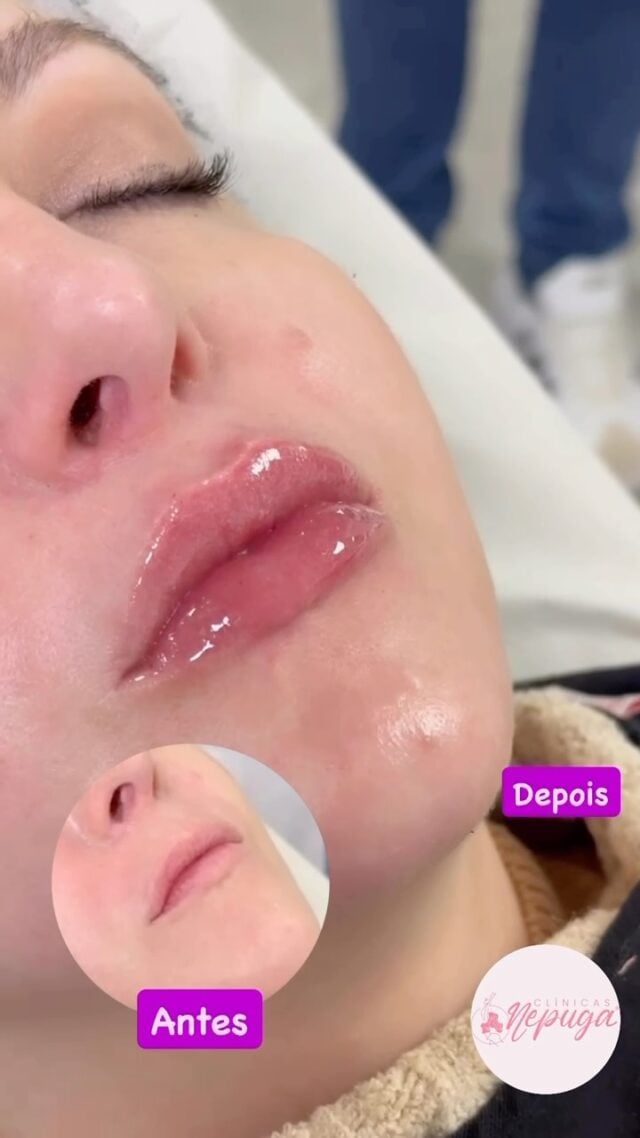 ✨ O Preenchimento Labial é a escolha das mulheres que querem realçar sua beleza de forma natural, sem exageros.
Agora é a sua vez de conquistar lábios mais volumosos, simétricos e marcantes – do jeitinho que sempre sonhou!

👄 Por que escolher a Clínica Nepuga®️?
✔️ Referência nacional em Harmonização Orofacial;
✔️ Equipe altamente capacitada, com profissionais atualizados nas melhores técnicas do mercado;
✔️ Ambiente seguro, higienizado e com estrutura premium;
✔️ Atendimento humanizado e avaliação individualizada;
✔️ Resultados naturais e personalizados para cada tipo de rosto.

📍Atendimento exclusivo em Campinas – SP
💼 Vagas limitadas para o procedimento de preenchimento labial!

📲 Fale agora com nossa equipe e agende sua avaliação:
👉 (19) 97161-9772

Na Clínica Nepuga®️, você não faz só um procedimento. Você investe na sua autoestima com segurança, técnica e excelência. 💕

#campinas #campinassp #mulheressp #campinascity #esteticacampinas #clinicasnepuga #campinascambui #taquaral #taquaralcampinas