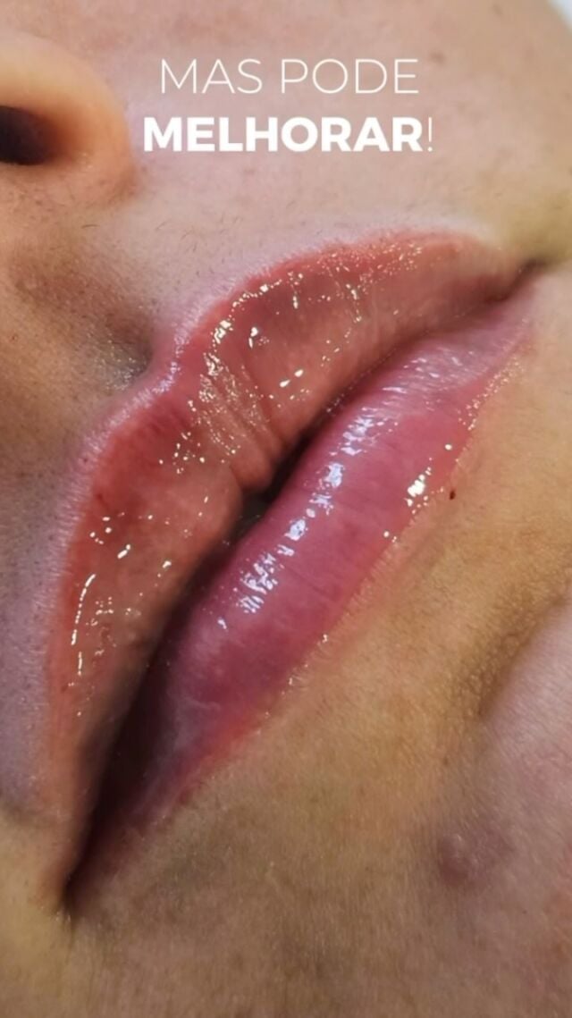 Preenchimento labial vai muito além de volume!

Na verdade, ele é o toque de sofisticação que realça o contorno, hidrata profundamente, suaviza as linhas finas e traz aquele “up” que transforma o rosto com naturalidade e elegância.

Quer um bocão? Dá pra conquistar!
Mas se você já ama o tamanho dos seus lábios e só quer valorizar o que já tem, esse protocolo é pra você.

E o segredo? Não é só o produto, é a TÉCNICA certa para o seu rosto e é isso que você encontra aqui, nas Clínicas Nepuga. 💋

#PreenchimentoLabial #BelezaNatural #HarmonizaçãoFacial #ClinicasNepuga #EstéticaAvançada #LábiosPerfeitos

*Esta imagem não representa, em hipótese alguma, garantia de resultado. Cada ser humano tem características anatômicas e fisiológicas únicas