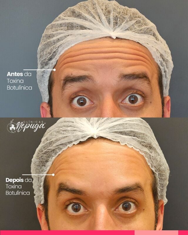 O antes e depois que você respeita!
A toxina botulínica suaviza rugas e linhas de expressão com naturalidade e eficácia.

💉O resultado final aparece entre 7 a 14 dias, revelando uma pele mais lisa, descansada e harmoniosa.

Quer rejuvenescer sem perder sua essência? Fale com a gente!

#Botox #ToxinaBotulinica #AntesEDepois #RugasSuavizadas #EstéticaComSegurança #BelezaNatural

*Esta imagem não representa, em hipótese alguma, garantia de resultado. Cada ser humano tem características anatômicas e fisiológicas únicas