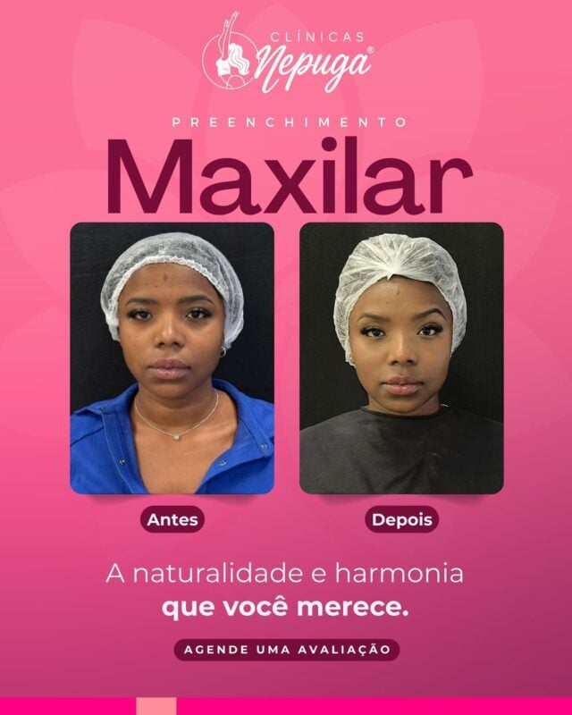 ✨ ANTES E DEPOIS DE UMA NOVA MULHER ✨
Essa é Bruna Francisca. Por fora, uma transformação impressionante.
Por dentro? Uma revolução completa.

Bruna chegou até a Clínica Nepuga®️ em busca de mais harmonia facial… mas o que ela realmente encontrou foi confiança, autoestima e o poder de se olhar no espelho e se reconhecer — e se admirar — novamente.

👩‍🔬 Uma abordagem inovadora de preenchimento facial com resultados naturais, progressivos e seguros, desenvolvida por especialistas da Nepuga®️ e aprovada pela Anvisa.

💼 Nas mãos de profissionais altamente renomados em harmonização orofacial, Bruna experimentou mais do que uma mudança estética.
Ela renasceu para a melhor versão de si mesma.

Hoje, Bruna sorri com mais liberdade, se expressa com mais leveza e vive com mais segurança.

E você, está esperando o quê para viver sua transformação?

📍 Agende sua avaliação personalizada na unidade Nepuga®️ 
🌟 Vagas limitadas! 

#goiânia #gyn #goianiashopping