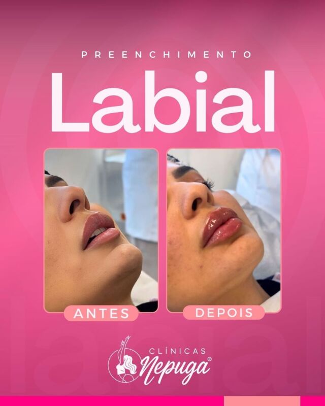 Goiânia - GO | Nepuga Unidades 9 💋 RESULTADO REAL! Antes e Depois do Preenchimento Labial na Clínica Nepuga®️Goiânia 💋
Você merece lábios com mais volume, definição e harmonia — e o preenchimento labial é a técnica ideal para realçar sua beleza natural!
📍 Confira o antes e depois incrível de uma de nossas pacientes!
✨ Resultado imediato;
✨ Contorno mais definido;
✨ Naturalidade preservada.
Na Clínica Nepuga®️, unimos tecnologia, expertise médica e o olhar estético de profissionais especializados em harmonização orofacial para entregar um resultado seguro e encantador.
👄 Está pronta para sua transformação?
📲 Agende agora sua avaliação pelo WhatsApp!
Vagas limitadas!
🧪 Procedimento realizado com produtos de alta qualidade e aprovação da Anvisa.
#goiânia #goiania #gyn #goianiashopping