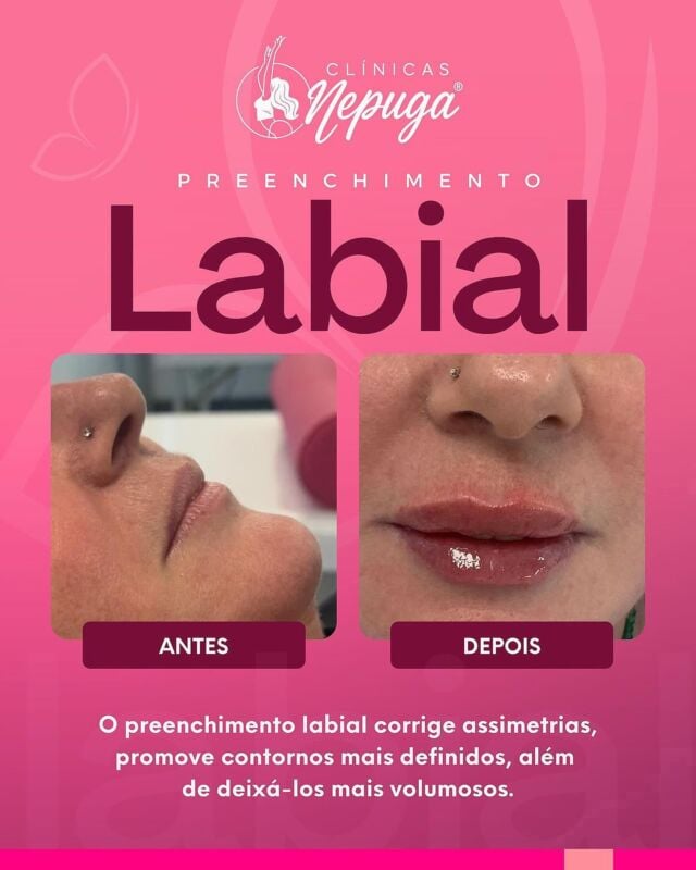 💋 O antes era bonito... mas o depois ficou simplesmente INCRÍVEL!
Na Clínica Nepuga®️, realçamos o que você tem de mais bonito com naturalidade, segurança e sofisticação.

✨ Resultado imediato;
✨ Lábios mais definidos e volumosos;
✨ Técnica exclusiva com aprovação da Anvisa.

👄 Sua vez de brilhar é agora!
📲 Agende sua avaliação!

#goiânia #gyn #goianiashopping
