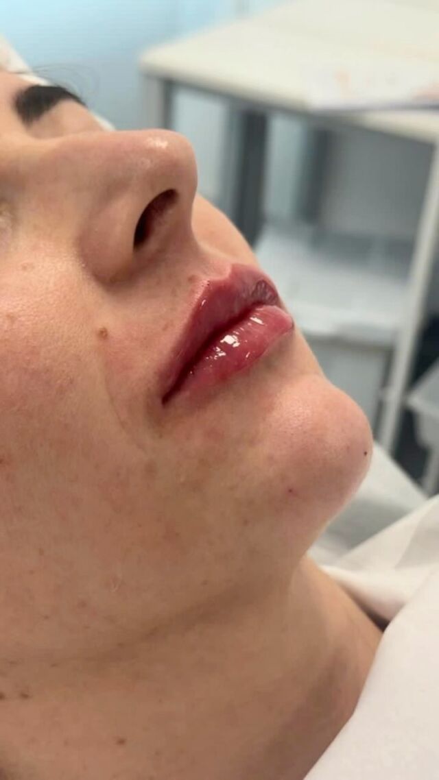 Você fez preenchimento labial e esse foi o resultado: autoestima lá em cima! 💋
Confiança renovada, sorriso mais leve e aquele toque de poder que só quem se ama de verdade entende.

#PreenchimentoLabial #AutoestimaRenovada #BelezaComPropósito #HarmonizaçãoFacial #ConfiançaQueTransforma