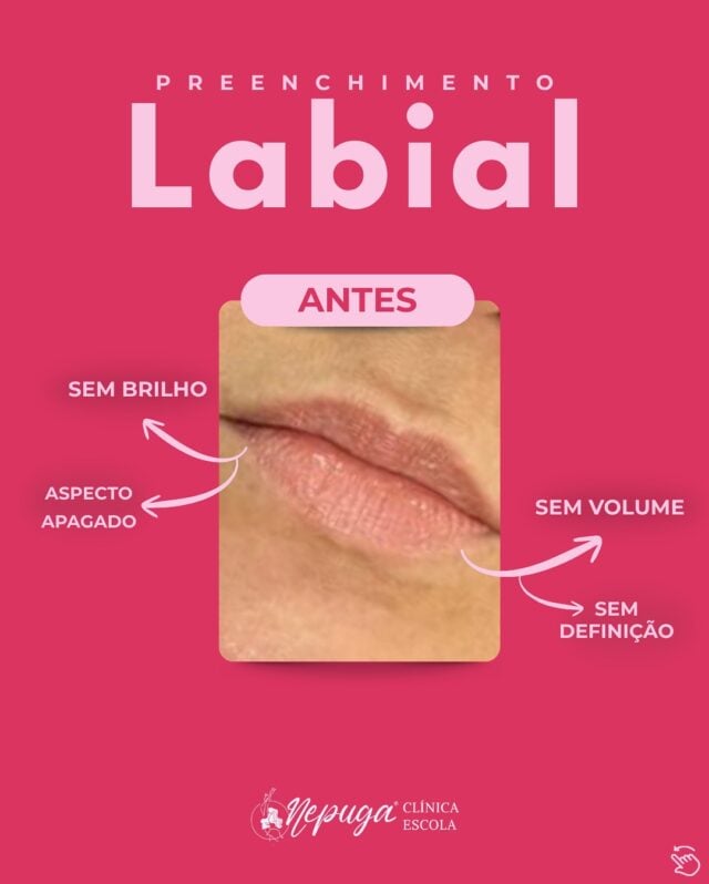 ✨ O que antes era apagado, sem brilho e sem definição… hoje é sinônimo de volume, saúde e confiança!

O Preenchimento Labial realça a beleza natural, devolvendo contorno e aquele efeito luminoso que transforma o sorriso.

💋 Mais do que estética, é autoestima em evidência.
📍 Agende sua avaliação e descubra a diferença!
