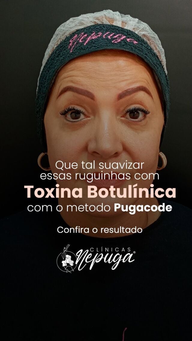 Cansada das rugas? 😔 
A Toxina Botulínica é a solução que você busca! Além de suavizar as linhas de expressão existentes, ela previne que novas marcas se formem, mantendo sua pele com aspecto mais jovem e natural.

Quer uma pele mais lisa e radiante? Clique no link da bio e agende sua consulta para um antes e depois que vai te surpreender!

#ToxinaBotulinica #Rejuvenescimento #PeleJovem #ClinicasNepuga #DraAnaCarolinaPuga #EsteticaFacial #AdeusRugas #BelezaNatural