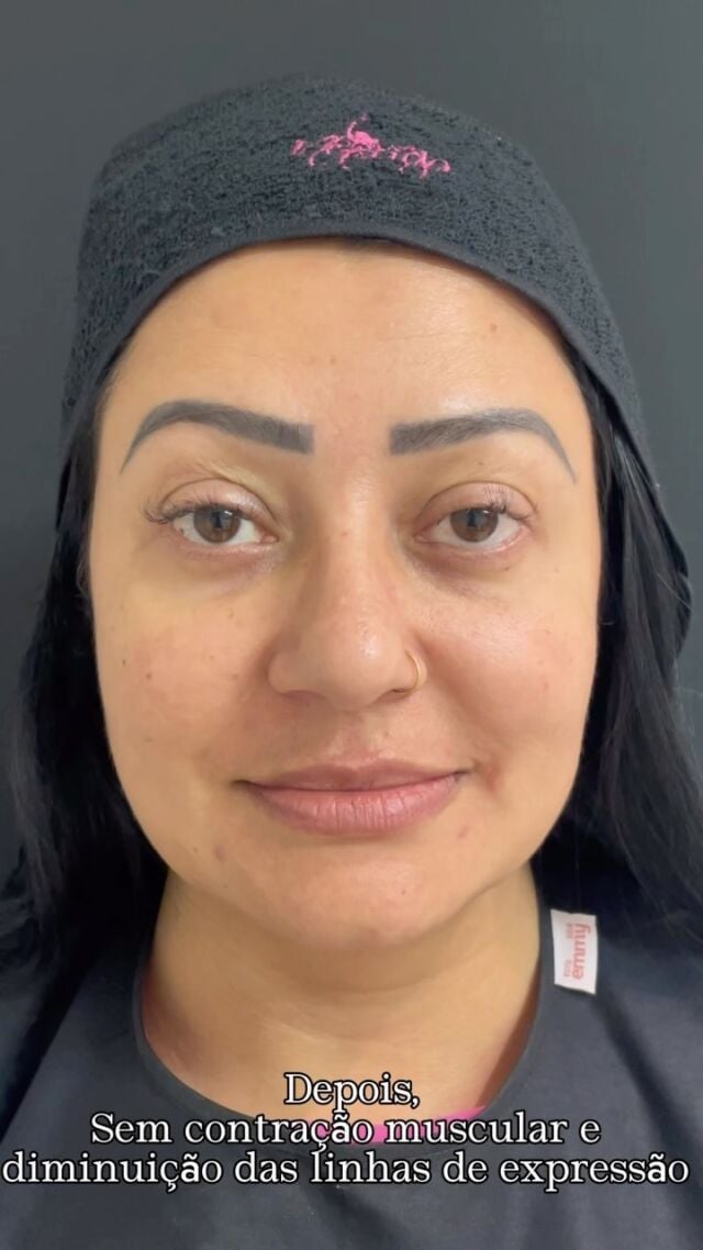 ✨TOXINA BOTULÍNICA É VIDA! 😍

👉🏻Nada melhor como um antes e depois incrível desses né?! 

🥰A toxina tem como objetivo evitar a contração muscular, provocando o relaxamento da região e reduzindo assim rugas e linhas de expressão provocadas pelo envelhecimento natural da pele ou pela ativação frequente da área.

💕Continue nos acompanhando para mais resultados como esse.

#toxinabotulinica #botox #estética #estetica #biomedicinaestetica #biomedicina #enfermagemestética #clinicanepuga #draanacarolinapuga #belezafeminina #belezaesaude