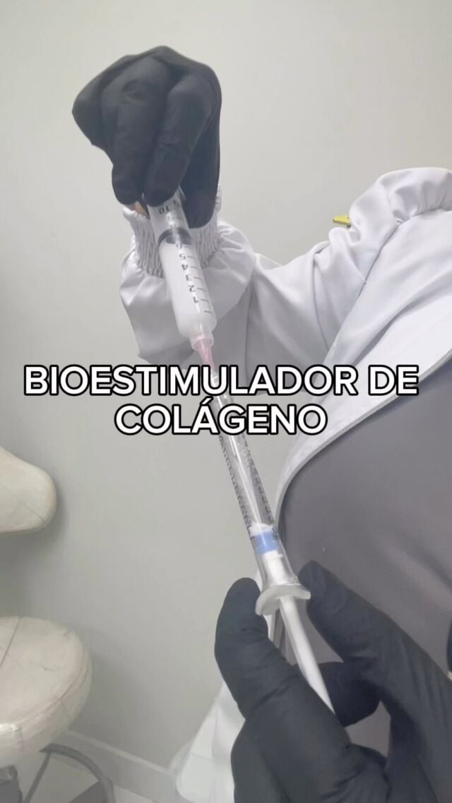 ✨BIOESTIMULADOR DE COLÁGENO✨

💕A paciente passou por avaliação e foi indicado o procedimento para produção de COLÁGENO🔥

🤔Quais os MEGA benefícios do bioestimulador e para que serve? 

👉🏻são ativos potentes que colaboram com a manutenção da saúde da pele, proporcionando aspecto mais firme e elástico, ajudando a suavizar rugas, linhas de expressão e também no preenchimento de sulcos e áreas mais profundas causadas pela flacidez facia

🤔Qual a duração?

👉🏻Normalmente, dura entre 18 a 24 meses no organismo, porém, geralmente devem ser feitas sessões de manutenção anuais para estimular o colágeno.

🤔Por que devo fazer?

👉🏻Além dos mega benefícios dos resultados que ele proporciona, AQUI, na clinica NEPUGA nós parcelamos em até 12x SEM juros, com um EXCELENTE custo benefício, para não pesar no seu bolso!

💕É um grande investimento na beleza né?! Fala sério!😍

#bioestimulador #bioestimuladordecolageno #biomedicinaestetica #enfermagemesteta #farmaciaesteta #saudeebeleza #belezanatural #rejuvenescimentofacial #draanacarolinapuga