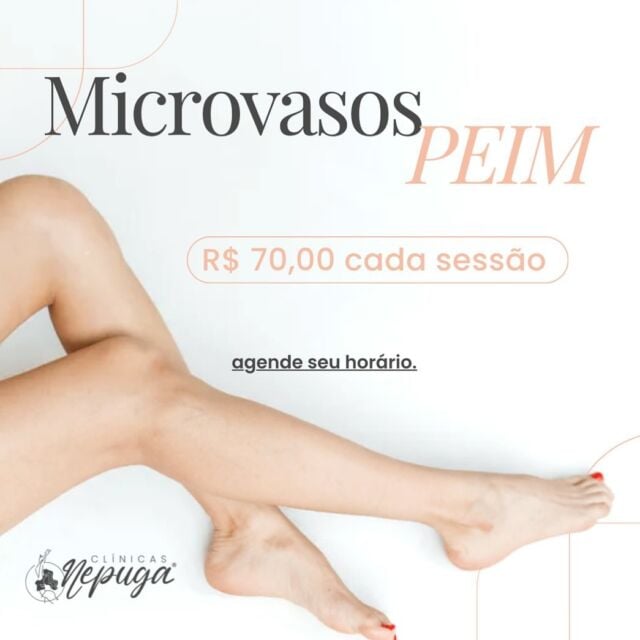 ✨Os temidos “vasinhos” nas pernas tem sido um incomodo frequente para as mulheres, fazendo com que a auto estima fique cada vez menor…
MAS, não se preocupe, nós temos a solução para este problema!👏🏻

Afinal, o verão está logo aí e precisamos nos sentir confortáveis e seguras com nosso corpo ao colocar um biquíni/ shorts, né?!

👉🏻o PEIM consiste na aplicação de substância esclerosante (glicose) com o objetivo de interromper o fluxo sanguíneo do vaso de forma local e de promover a secagem do vaso, fazendo que desapareça!

🔥Agende seu horário e livre-se dos indesejados microvasos nas pernas🔥

#peim #peimmicrovasos #microvasos #microvasosestéticos #estetica #saúde #saudeebeleza #mundodaestetica #biomedicinaestética #enfermagemestetica #clinicadeestetica #clinicasnepuga #draanacarolinapuga